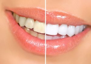 Woman’s smile before and after professional teeth whitening treatment