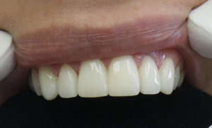 Close-up of patient’s teeth after placement of veneers and Lumineers