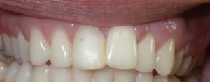 Close-up of patient’s teeth prior to treatment by Dr. Makadia, a cosmetic dentist  