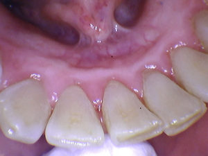 Patient’s teeth after gum disease treatment at Sunrise Dental Service