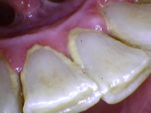 Patient’s teeth before gum disease treatment at Sunrise Dental Service