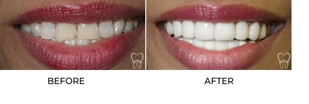 Before and after picture of porcelain veneers