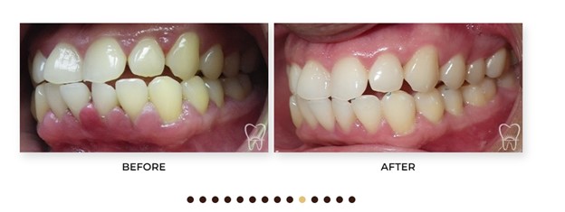 Gum treatment by Dr. Makadia with laser