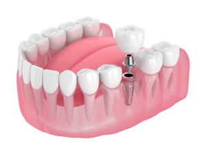 Illustration of lower jaw with single dental implant