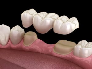 Illustration of three-unit dental bridge