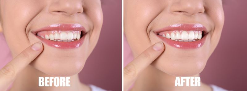 Young woman’s smile before and after gum recontouring