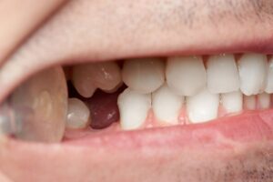 Close-up of man's mouth with a missing premolar