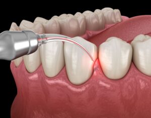 Dental laser being used for gum procedure