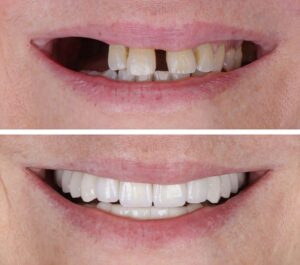 Close-up of patient’s teeth before and after smile makeover