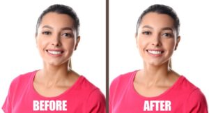 Portrait of smiling woman before and after gum recontouring