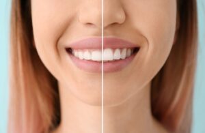 Woman's smile before and after gum recontouring