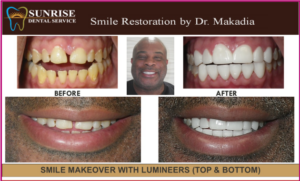 Before and after images of smile makeover patient at Sunrise Dental Service